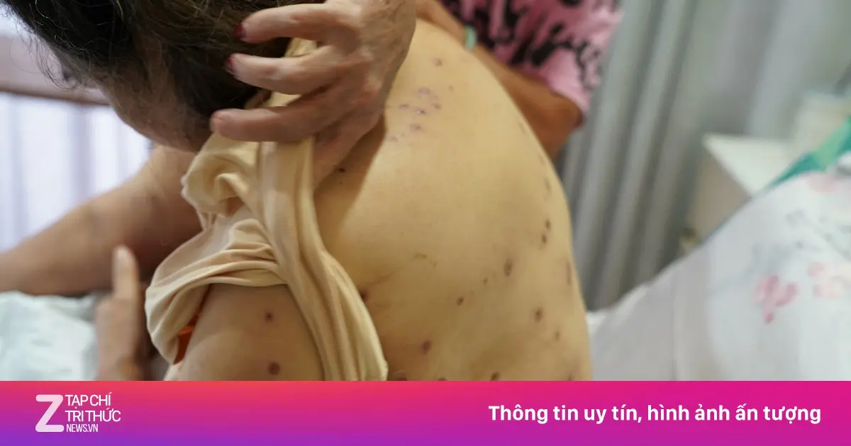 74pvyt Nhieu vet dot o dau mat lung tay chan 2