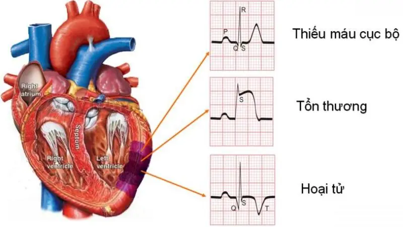 ir8gi7 ecg nhoi mau co tim xet nghiem