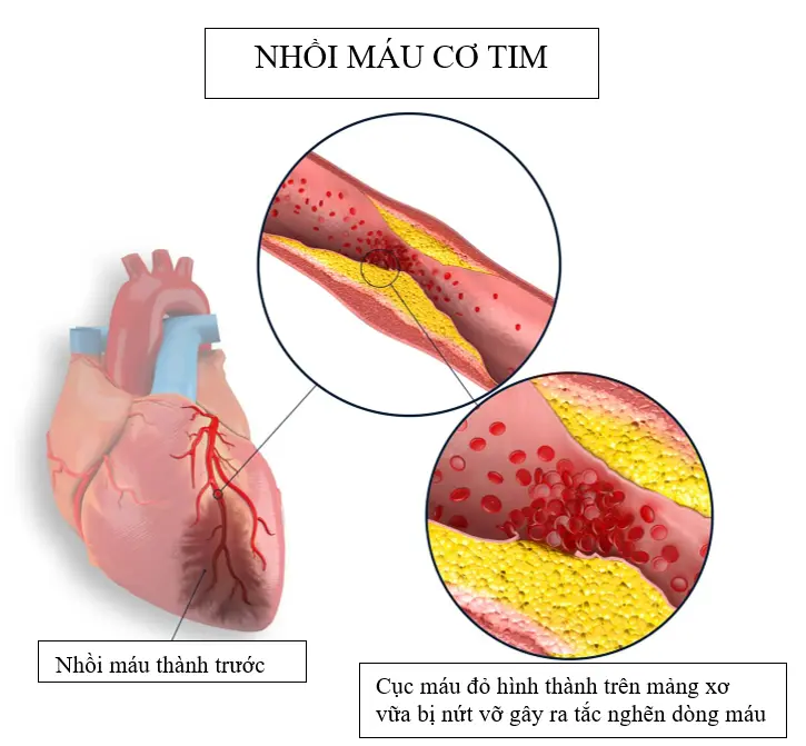 it1ndv nhoi mau co tim2