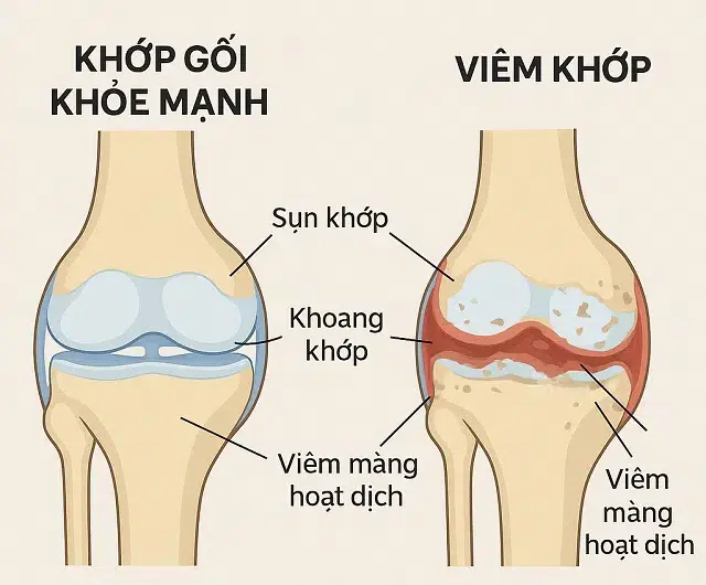 mh6d2j khop goi bi viem.jpg