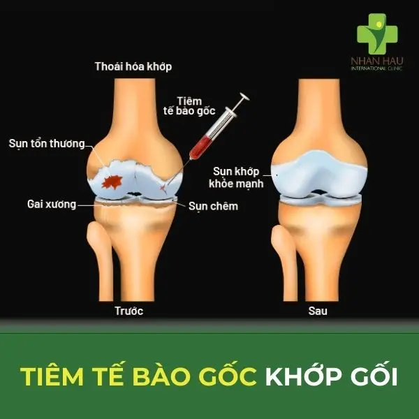 veur6c tiem te bao goc khop goi
