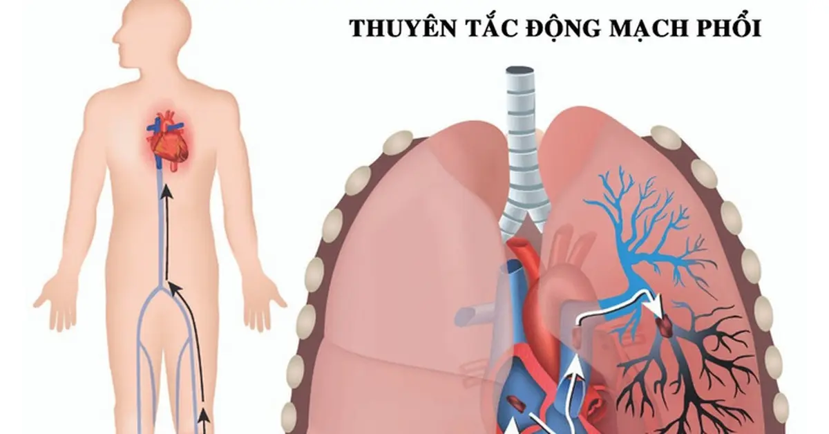 xvckik thuyen tac dong mach phoi 17133151899821877588396 1713405946378314240348 16 0 398 730 crop 171340599378789439153