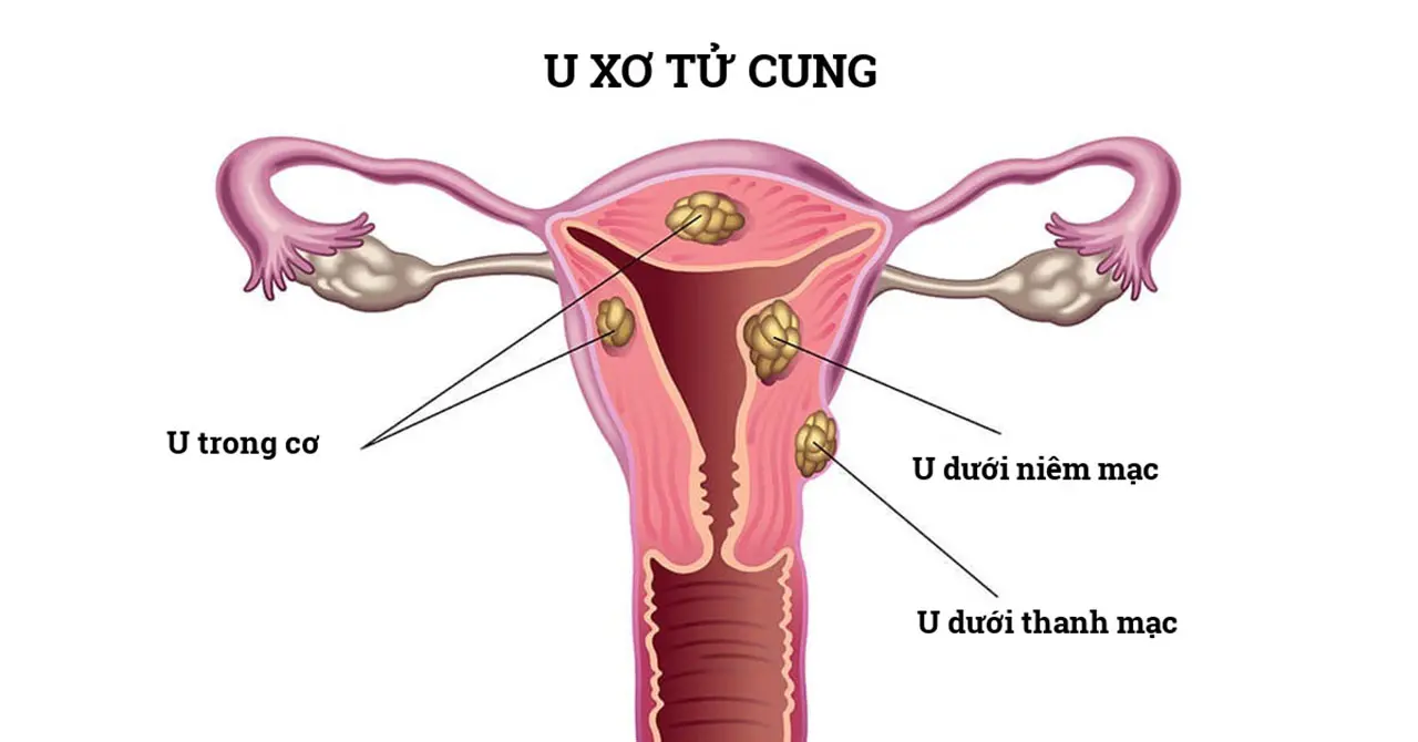 xgh4et vi tri u xo tu cung thumb