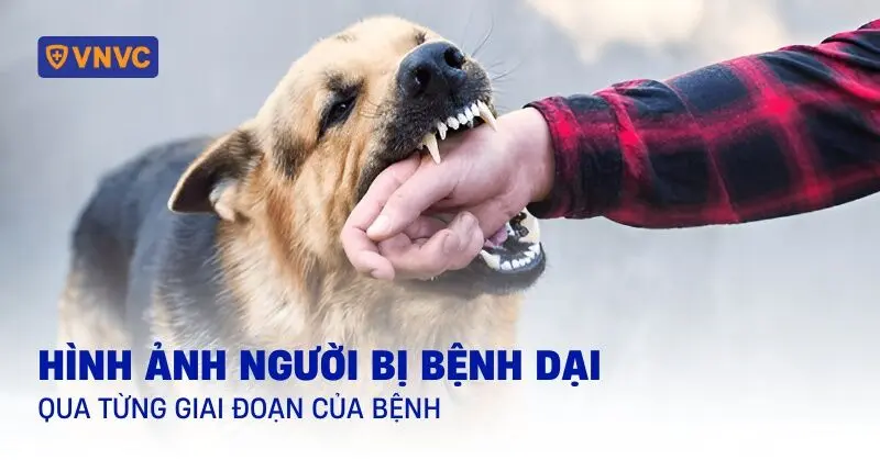 dpfkxt hinh anh nguoi bi benh dai