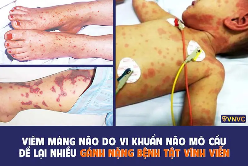 qgmi7h viem mang nao do khuan mo cau o tre