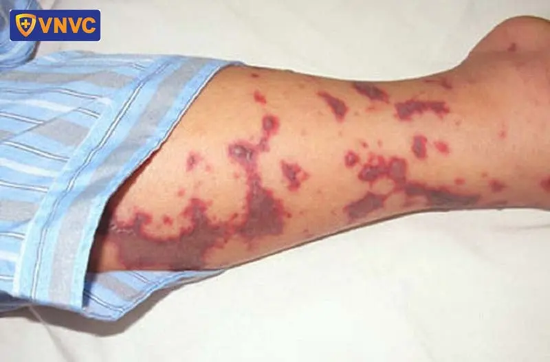 w8ugbh dau hieu cua benh nao mo cau bc